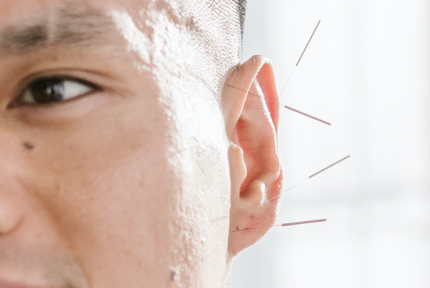Gesicht im Anschnitt, Ohr mit Akupunkturnadeln